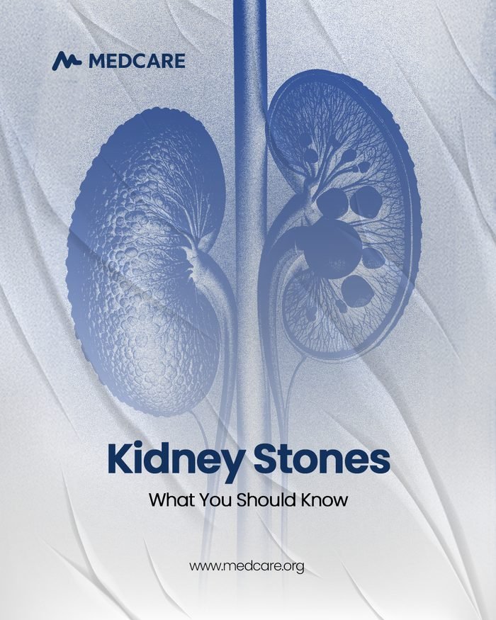 Kidney Stones — what you should know