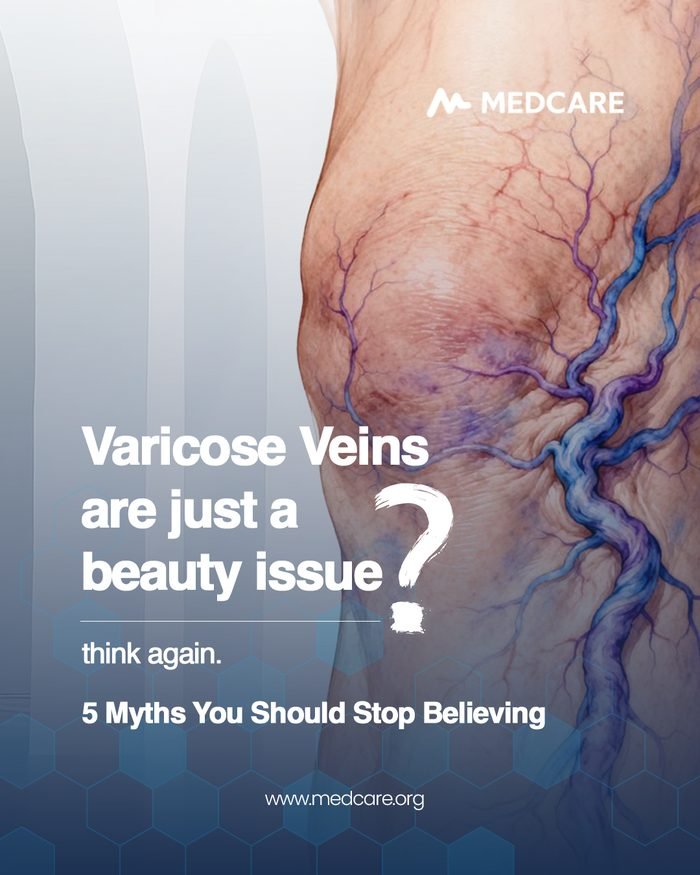 Varicose veins myths poster